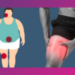 The Impact of Obesity on Knee Health and Replacement Surgery
