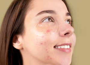 Woman with acne using under-eye skincare patches, representing skincare struggles and medical gaslighting in dermatology